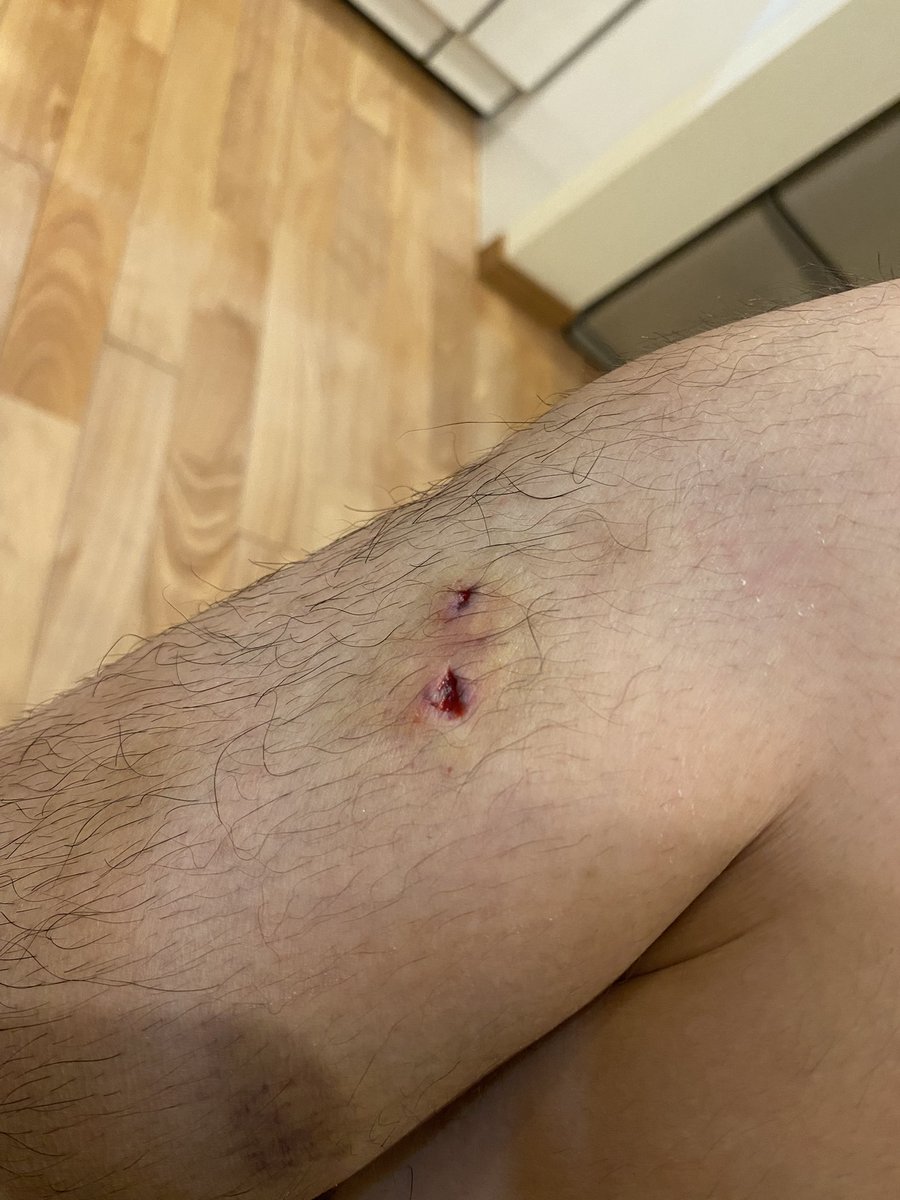 ryusuke0814's tweet photo. ヒラスの代償ステキ針フッキング
貫通したのをカエシ潰して自分抜くのは地獄😅 https://t.co/SBgyV2Sk09