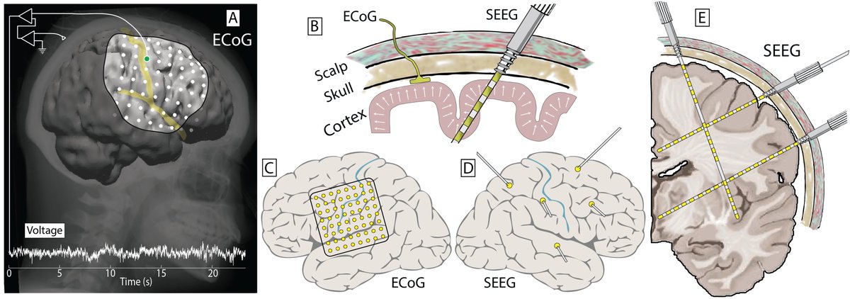 Decision making in stereotactic epilepsy surgery with Anthony Fine onlinelibrary.wiley.com/doi/abs/10.111… <a href="/EpilepsiaJourn/">Epilepsia</a> <a href="/MayoClinicNeuro/">Mayo Clinic Neuro</a>