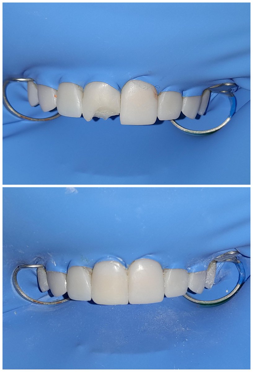 Dental24_7's tweet image. Regresando al diente su forma con resina #Prosthodontics #DirectComposite #EstheticDentistry #RestorativeDentistry #Dentista #Dental #Veneers #DentalVeneer #DentalArt #Dentistry #OdontologiaEstetica #Dentures #Dentist #TeethWhitening #CosmeticDentistry #Odontología #DentalClinic
