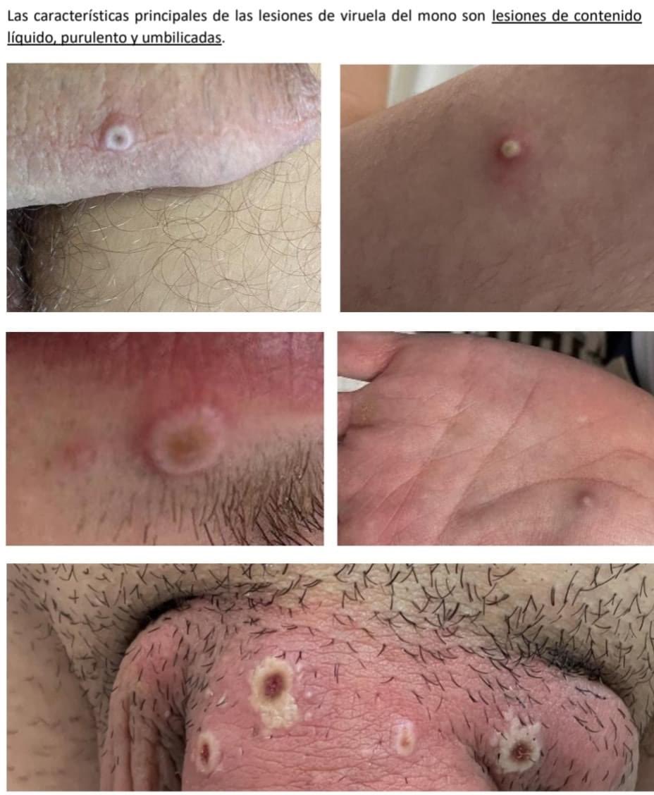 slavco37's tweet photo. Ojalá y lo compartan broos
neta que esto es real 
CUADRO CLÌNICO Y LESIONES CARACTERISTICAS DE VIRUELA SÌMICA ( MONKEYPOX ).
Muchos medios comparte que la mayoría de los casos es por la comunidad 🏳️‍🌈🏳️‍🌈🏳️‍🌈
NADIE ES DIOS Y NADI ESTÁ EXCENTO https://t.co/EO26IlQTQA