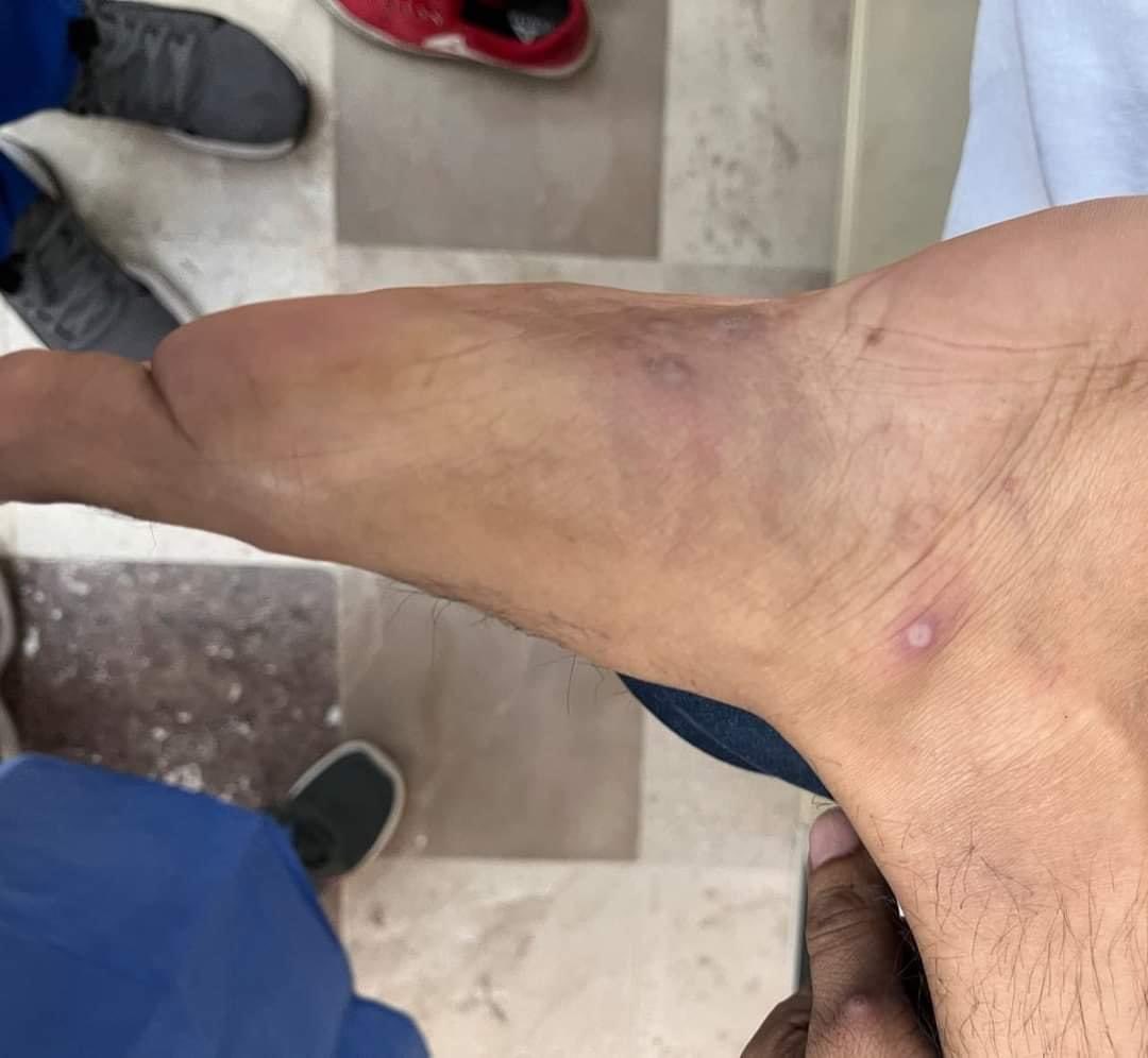 slavco37's tweet photo. Ojalá y lo compartan broos
neta que esto es real 
CUADRO CLÌNICO Y LESIONES CARACTERISTICAS DE VIRUELA SÌMICA ( MONKEYPOX ).
Muchos medios comparte que la mayoría de los casos es por la comunidad 🏳️‍🌈🏳️‍🌈🏳️‍🌈
NADIE ES DIOS Y NADI ESTÁ EXCENTO https://t.co/EO26IlQTQA