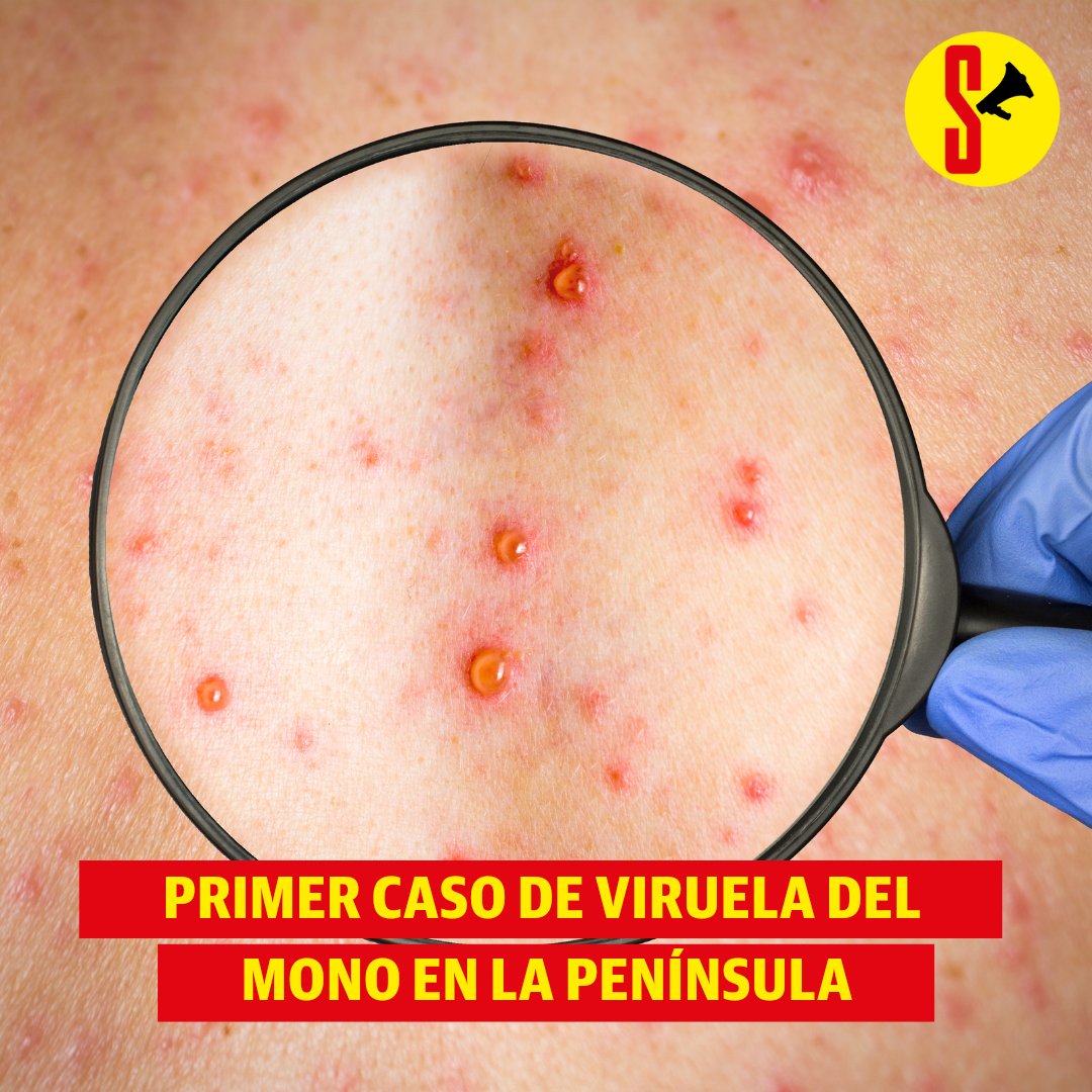 winstong_rf's tweet photo. 🚨El paciente corresponde al cantón #LaLibertad  en la #ProvinciaDeSantaElena  y permanece en aislamiento domiciliario. Autoridades informaron del caso de #ViruelaDelMono la mañana de este lunes 8 de agosto. https://t.co/wtKKrE3XeC