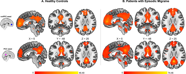 New paper by Carly Hunt, @JanelleLetzen et al

Is mindfulness associated with lower pain reactivity and connectivity of the default mode network? A replication and extension study in healthy and episodic migraine participants jpain.org/article/S1526-…