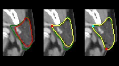 Radiology: Artificial Intelligence (@radiology_ai) on Twitter photo #DeepLearning models help clinicians edit contours efficiently and effectively doi.org/10.1148/ryai.2… <a href="/SteveJiangPhD/">Steve Jiang</a> <a href="/UTSW_RadOnc/">UTSW Radiation Oncology</a> #RadOnc #RadiationTherapy #AI #DeepLearning models help clinicians edit contours efficiently and effectively doi.org/10.1148/ryai.2… <a href="/SteveJiangPhD/">Steve Jiang</a> <a href="/UTSW_RadOnc/">UTSW Radiation Oncology</a> #RadOnc #RadiationTherapy #AI