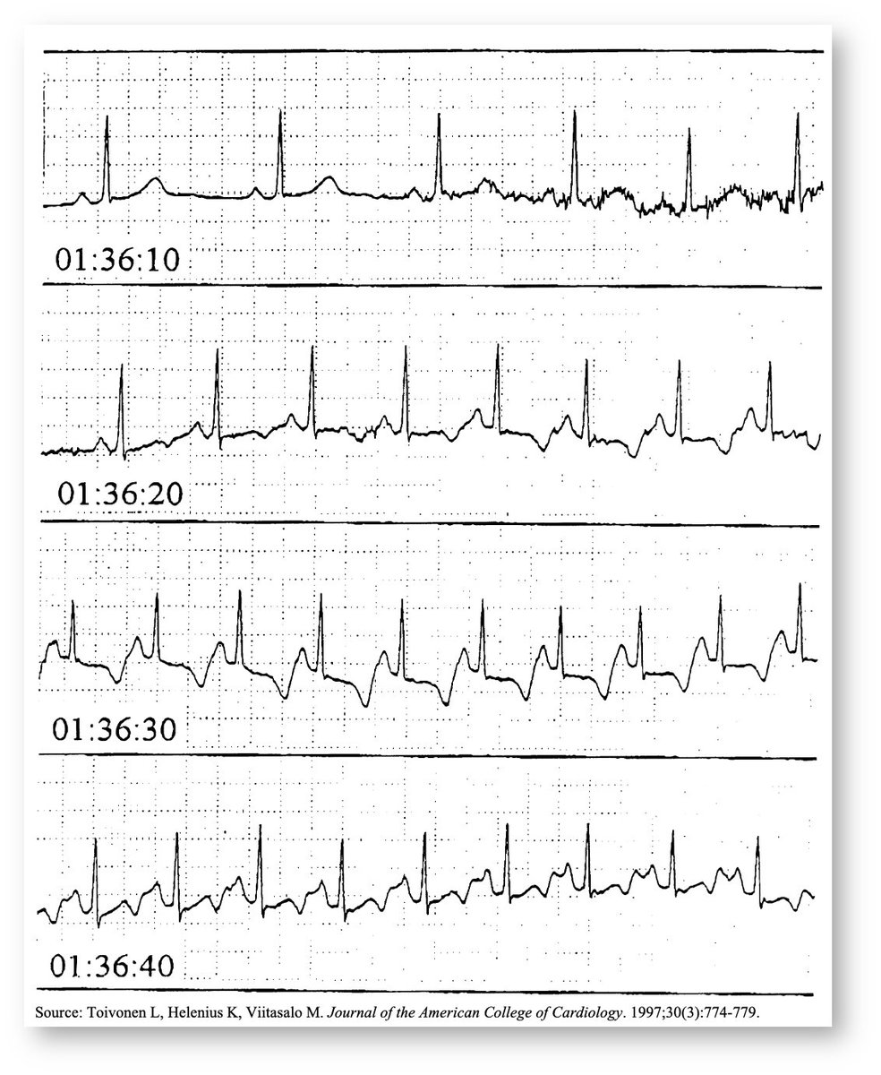 1/4 - The Mystery A doctor is on overnight call in the hospital. They are also hooked up to continuous ECG monitoring. 🤔What might cause the following tracing?