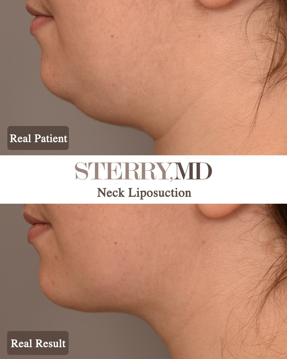 Check out that jawline 🤩

Her before &amp; after photos are 3 months apart, we were thrilled to see my beautiful patient and I am so excited to see her doing great! 

#chinliposuction #chinliponyc #beforeandafterliposuction #doublechinremoval #submentalfat