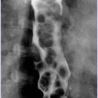 47 year old patient with history of excessive alcohol intake presents with vomitting of blood. Diagnosis? Answer link in prior tweet. #radiology #meded #medtwitter #GITwitter #foamed #foamrad #radres #radtwitter