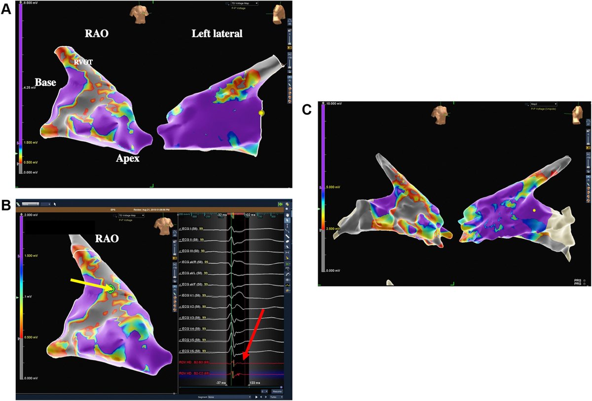 #EPeeps The pdf of commentary by <a href="/PittCardiology/">Pitt Cardiology</a> colleagues and me on a fascinating <a href="/HRS_CaseReports/">Heart Rhythm Case Reports</a> paper on exercise induced ARVC is now available at: heartrhythmcasereports.com/article/S2214-…

Figure from original report by <a href="/djdardenMD/">Doug Darden</a> et al., available at: heartrhythmcasereports.com/article/S2214-…