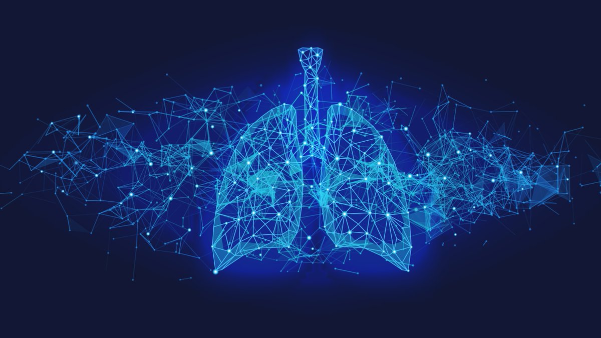 univ_paris_cite's tweet photo. #BestOff2022 I Cancer du poumon métastatique : identification de la dépense énergétique de repos comme biomarqueur de la sensibilité à l’immunothérapie anti-cancéreuse. @hopitalcochin ➡️ https://t.co/BUFJwEoLe6 https://t.co/rA1JTRfjcc