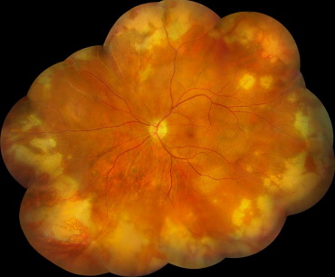 Acute retinal necrosis (ARN) is an inflammatory condition that may present as panuveitis. The principal causative viral agents have been found to be Varicella Zoster Virus as well as Herpes Simplex Virus via polymerase chain reaction testing of intraocular fluid.
#retinalnecrosis