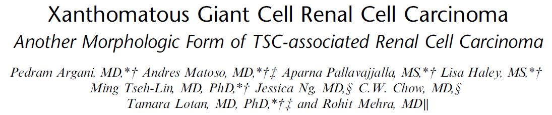angelpanizo1's tweet photo. A new kid on the block... "Xanthomatous Giant Cell Renal Cell Carcinoma: Another Morphologic Form of TSC-associated Renal Cell Carcinoma" Am J Surg Pathol. 2022 Aug 8 PMID: 35941720
https://t.co/eJQ0y73gDp
@Andres_Matoso @drmehrarohit #gupath https://t.co/UaIFW9Ejht