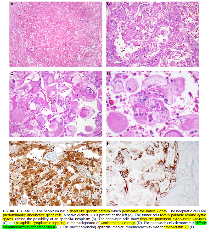 angelpanizo1's tweet photo. A new kid on the block... "Xanthomatous Giant Cell Renal Cell Carcinoma: Another Morphologic Form of TSC-associated Renal Cell Carcinoma" Am J Surg Pathol. 2022 Aug 8 PMID: 35941720
https://t.co/eJQ0y73gDp
@Andres_Matoso @drmehrarohit #gupath https://t.co/UaIFW9Ejht