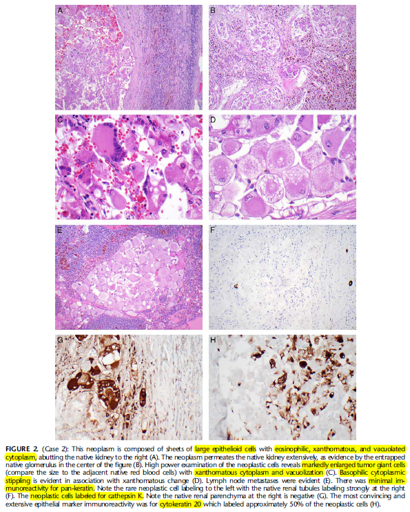 angelpanizo1's tweet photo. A new kid on the block... "Xanthomatous Giant Cell Renal Cell Carcinoma: Another Morphologic Form of TSC-associated Renal Cell Carcinoma" Am J Surg Pathol. 2022 Aug 8 PMID: 35941720
https://t.co/eJQ0y73gDp
@Andres_Matoso @drmehrarohit #gupath https://t.co/UaIFW9Ejht