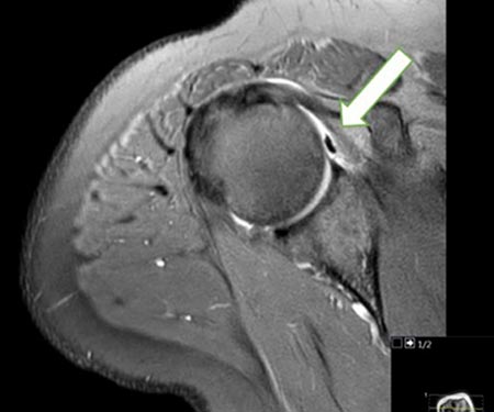 SEMG_ES's tweet photo. #RMGyF El hombro congelado, también llamado #capsulitis adhesiva, periartritis escapulohumeral o capsulitis fibrótica, es una alteración caracterizada por una restricción funcional de los movimientos activos y pasivos del hombro.
📖 Consulta el caso en https://t.co/RyXIU6d1zL https://t.co/CpWw5ctHU4