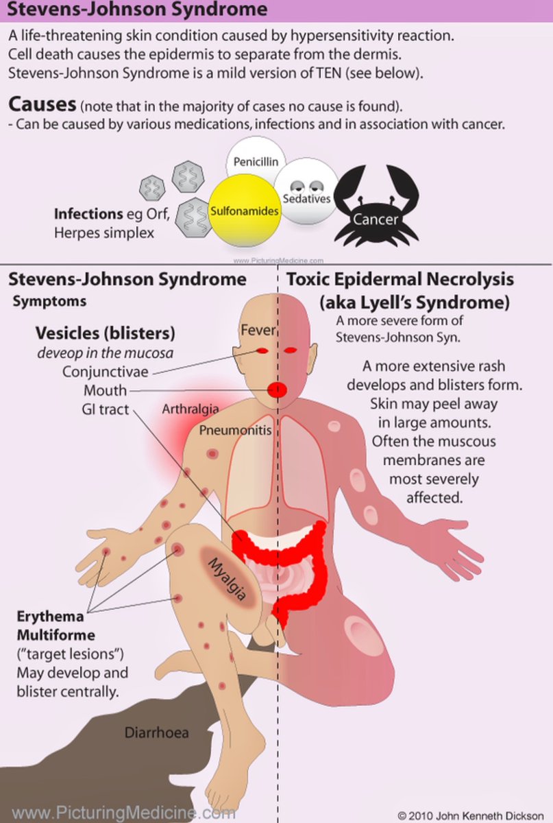 Stevens Johnson Syndrome Signs