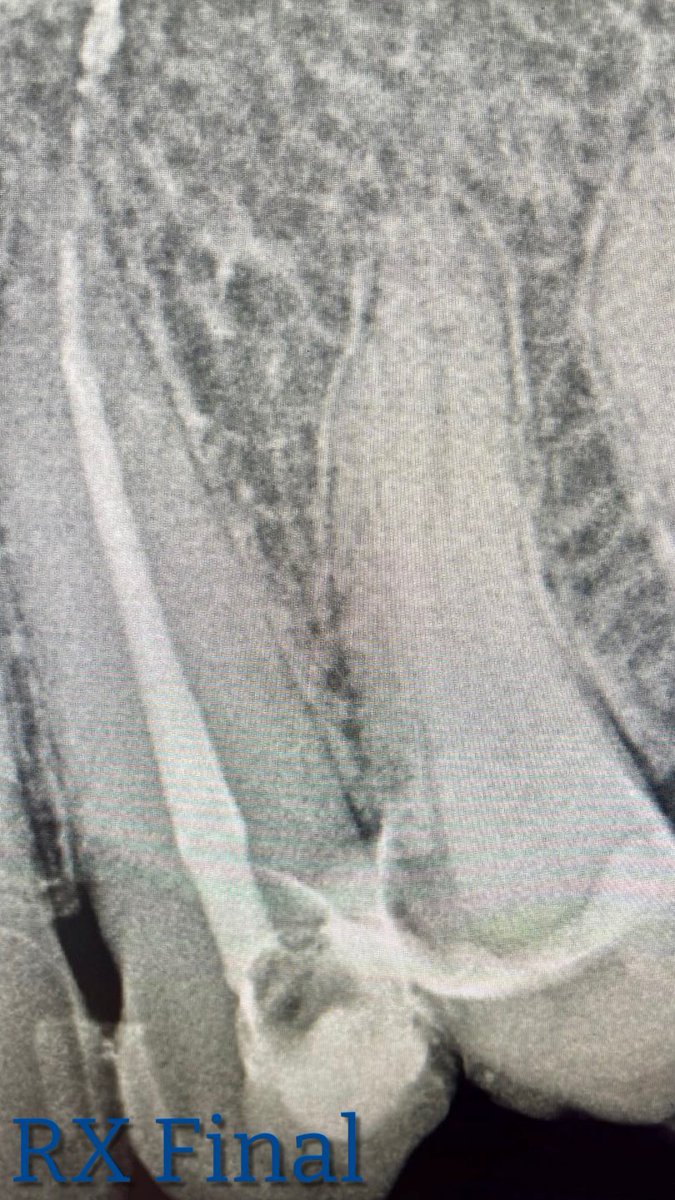 drpmdfuentes's tweet image. Tratamiento en #caninosuperior con #caries profunda y #pulpitis Se extrae #nerviodental y se trabaja en #endodoncia 🦷🦷🦷 #pacientefeliz #endodontics #toothdecay #saluddental #dentista #madrid #felizmartes #happytuesday #loveendodontics #lovemyjob #smile