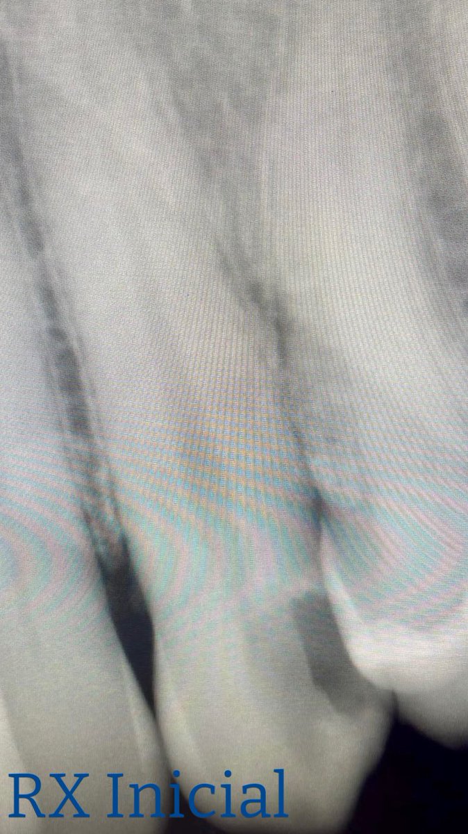 drpmdfuentes's tweet image. Tratamiento en #caninosuperior con #caries profunda y #pulpitis Se extrae #nerviodental y se trabaja en #endodoncia 🦷🦷🦷 #pacientefeliz #endodontics #toothdecay #saluddental #dentista #madrid #felizmartes #happytuesday #loveendodontics #lovemyjob #smile