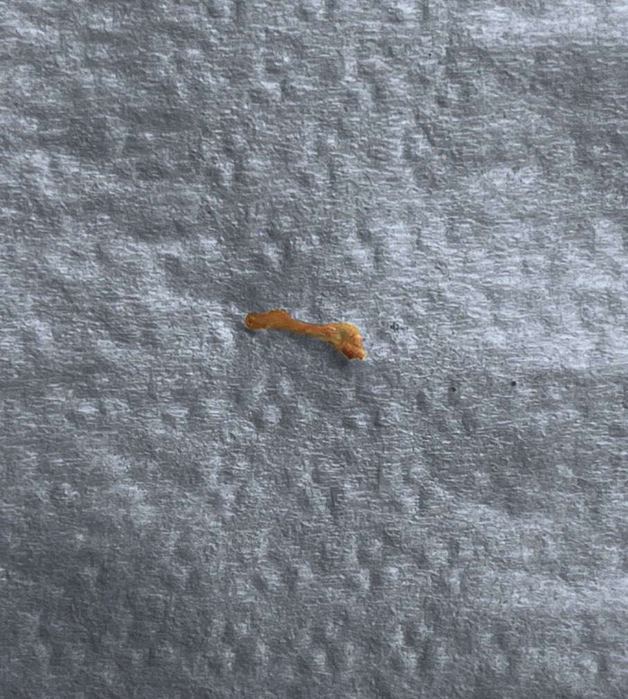 drpmdfuentes's tweet image. Tratamiento en #caninosuperior con #caries profunda y #pulpitis Se extrae #nerviodental y se trabaja en #endodoncia 🦷🦷🦷 #pacientefeliz #endodontics #toothdecay #saluddental #dentista #madrid #felizmartes #happytuesday #loveendodontics #lovemyjob #smile