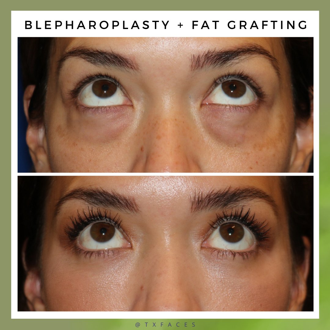 txfaces's tweet photo. This patient was treated with lower blepharoplasty (eyelid surgery) and fat grafting -- full under-eye rejuvenation!

Procedure performed by Matthew Richardson, MD. https://t.co/QWnmL3uv7A