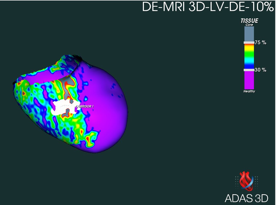 El <a href="/ADAS3D/">ADAS3D Medical</a> pronostica el canal de la TV en la capa 10% endocárdica de la cara inferior para el partido de mañana … si falla activaremos la 5ª palanca
<a href="/ivroca/">Ivo Roca, FEHRA, FESC</a> mañana la solución …