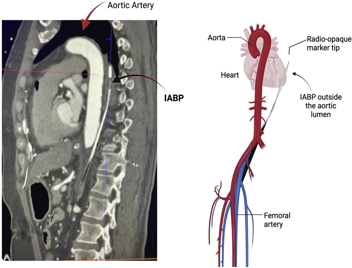 Julia Grapsa MD, PhD (@jgrapsa) on Twitter photo Aortic Perforation and Ascending Dissection Due to IABP ➡️ lnkd.in/dqCkCbCm
#jacccasereports #jaccjournals
#complications #surgery #IABP #aorta
<a href="/JACCJournals/">JACC Journals</a> <a href="/rafavidalperez/">rafavidalperez</a> <a href="/fischman_david/">David L. Fischman</a> <a href="/mividovich/">Mladen Vidovich</a> <a href="/MinnowWalsh/">Minnow Walsh, MD, MACC</a> <a href="/EstefaniaOS/">Estefania Oliveros MD🫀</a> <a href="/gina_lundberg/">Gina Lundberg MD FACC FAHA</a> <a href="/IndahSP_MD/">Indah Sukmawati, MD</a> Aortic Perforation and Ascending Dissection Due to IABP ➡️ lnkd.in/dqCkCbCm
#jacccasereports #jaccjournals
#complications #surgery #IABP #aorta
<a href="/JACCJournals/">JACC Journals</a> <a href="/rafavidalperez/">rafavidalperez</a> <a href="/fischman_david/">David L. Fischman</a> <a href="/mividovich/">Mladen Vidovich</a> <a href="/MinnowWalsh/">Minnow Walsh, MD, MACC</a> <a href="/EstefaniaOS/">Estefania Oliveros MD🫀</a> <a href="/gina_lundberg/">Gina Lundberg MD FACC FAHA</a> <a href="/IndahSP_MD/">Indah Sukmawati, MD</a>