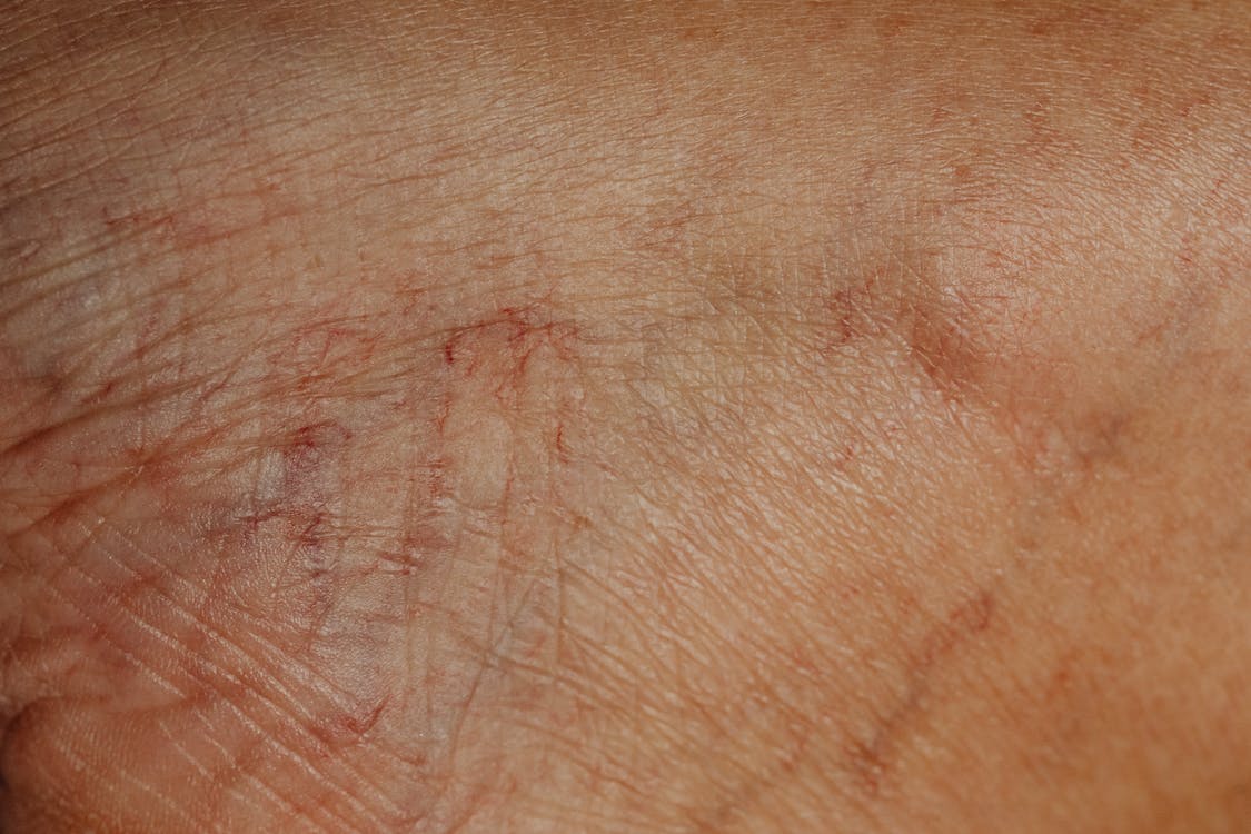 StocktonDerm's tweet photo. Swollen and twisted veins are known as varicose veins, it is something that can affect both women and men. The symptoms of varicose veins are aching legs, heaviness in the lower legs and feet, itchiness, and cramps. 

https://t.co/AFf0hu4eiP  

#VaricoseVeins #Treatment https://t.co/aszQBV2vF3