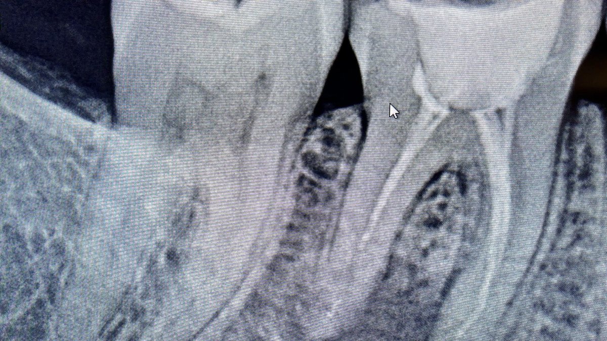 drpmdfuentes's tweet photo. Tratamiento de #reendodoncia en #pieza46 por conducto #sin #obturar .Consulta en @clinicadresmartinez con #protapernext de @dentsplysirona.iberia 😉 ¡Por un #paciente #sindolor ! 🦷 #reendodontics #tardedeverano #dental #smile #nopain #limas #dentalife #trabajobienhecho #madrid https://t.co/lVudm2eM6x