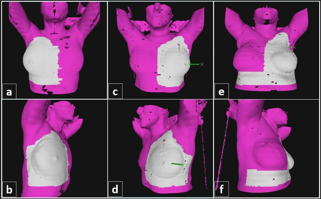 New in #PracticalRO: Tattoo-free radiation treatment for breast cancer with regional nodal RT reduces treatment time @RachelJimenezMD @MGHCancerCenter ➡️ bit.ly/3JGBOOQ #RadOnc #bcsm