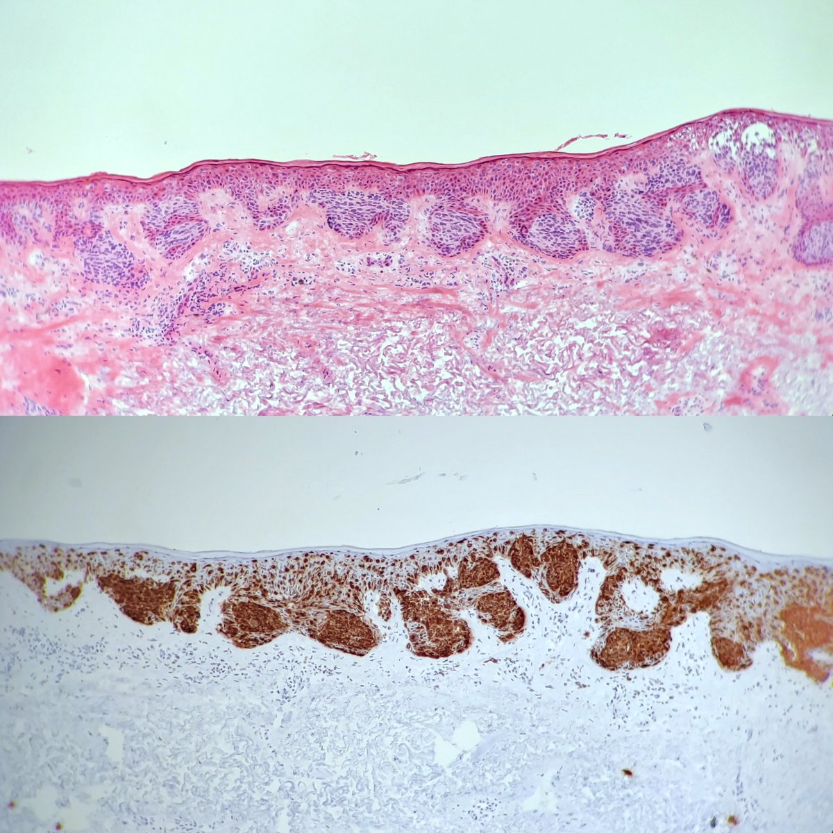 drvitalyt's tweet photo. Mohs surgery frozen section of the day - 

Melanoma in situ stained with both H &amp; E and MART-1. 

Note the proliferation of melanocytes arranged as single units and nests at the dermal-epidermal junction and as single cells above it. https://t.co/roqz1JMvhg