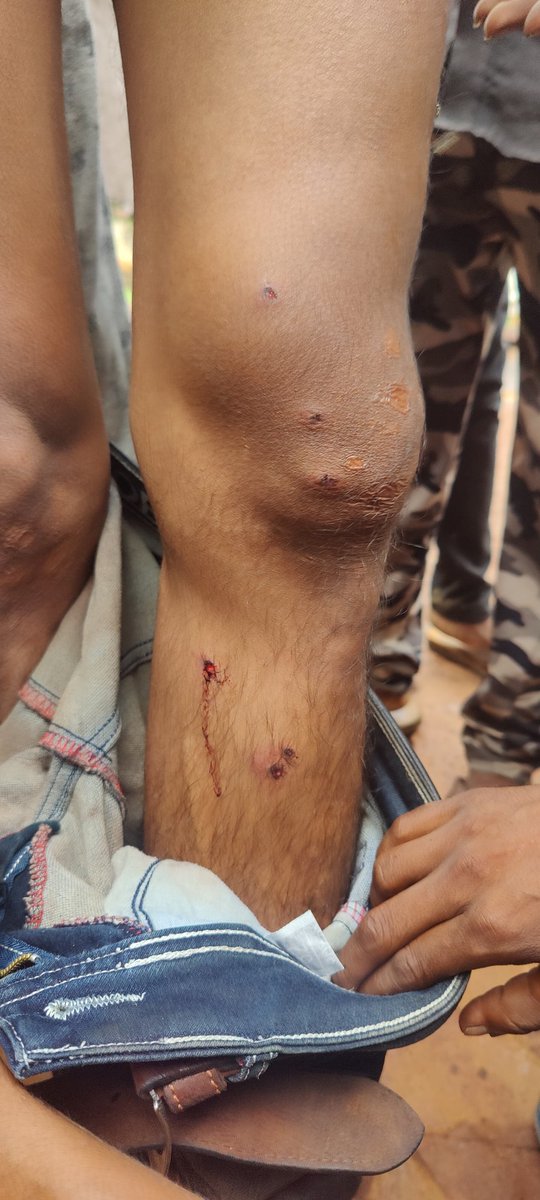विदिशा-आदिवासी भील परिवार के 10 सदस्यो पर लटेरी वनविभाग द्वारा बेहद शर्मनाक हमला जिसमे चैनसिंह पुत्र सरदार भील की मौके पर मौत एवं 4 अन्य गंभीर को जिला विदिशा हॉस्पिटल उपचार के लिए भेज दिया! विश्व आदिवासी दिवस पर आदिवासी को तोहफा धन्यवाद शिवराज 😭
<a href="/narendramodi/">Narendra Modi</a> 
<a href="/rashtrapatibhvn/">President of India</a>