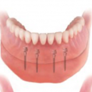 Removable partial dentures are for patients who are missing only some of their teeth on a particular arch. Fixed partial dentures, better known as crowns and bridges, are also for patients missing only some of their teeth, the Affordable Dentistry rockford IL will help you.