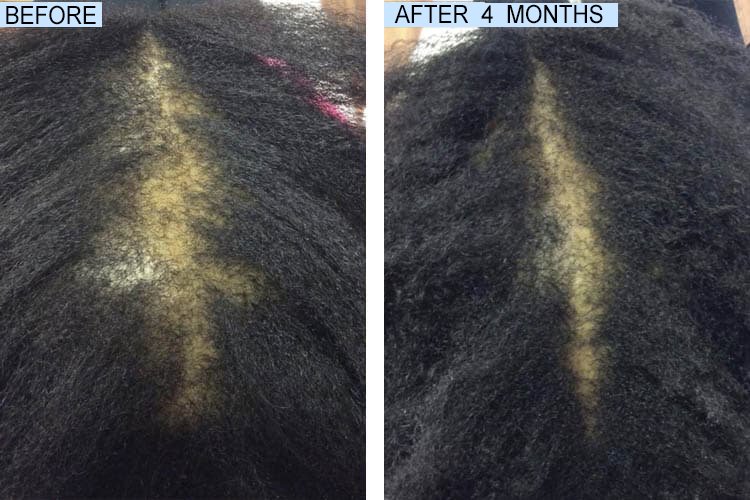 weightft's tweet image. FULLY VITAL HAIR GROWTH SYSTEM

This 100% natural hair system works from the inside out and outside in.

CLICK HERE TO ORDER OR TO LEARN MORE: bit.ly/FullyVito

#hairgrowth #hair #haircare #naturalhair #healthyhair #hairgoals #hairloss #hairstyles #beauty #curlyhair