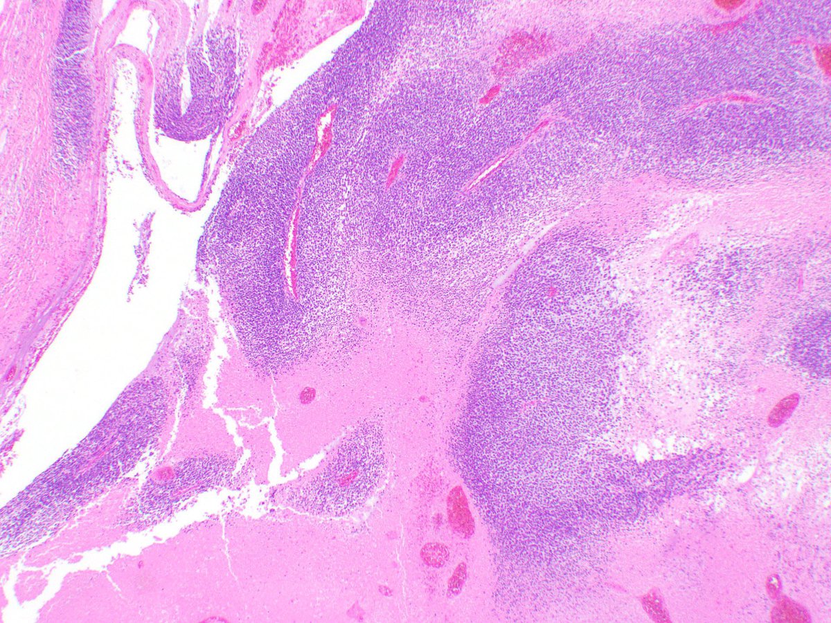 A. Cristina Vargas (@cristina_vargap) on Twitter photo #BST
Remember that this rare sarcoma type can present in young but also older adults.
Soft tissue mass in a male mid 50s. 
Colleague’s case who agreed to post his case 🙏 #BST
Remember that this rare sarcoma type can present in young but also older adults.
Soft tissue mass in a male mid 50s. 
Colleague’s case who agreed to post his case 🙏