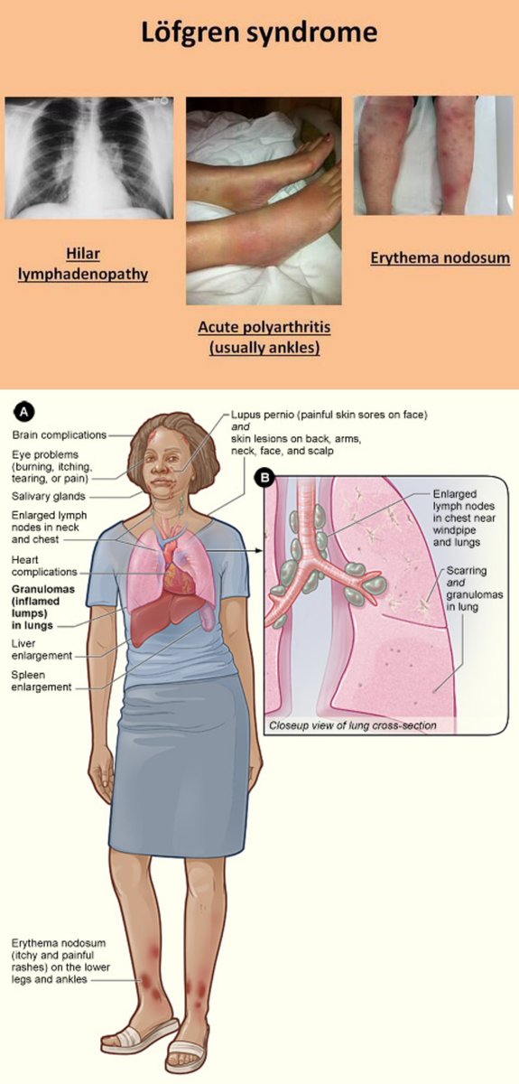 Sthanu (@Sthanu5) on Twitter photo 2022-08-10 15:38:30 @AaronGoodman33 Löfgren syndrome type of acute sarcoidosis erythema nodosum (especially of the lower extremities),bilateral arthritis of the ankle joints, and hilar lymphadenopathy. described by Sven Halvar Löfgren, a Swedish clinician. NSAIDs,Colchicine or low-dose prednisone @AaronGoodman33 Löfgren syndrome type of acute sarcoidosis erythema nodosum (especially of the lower extremities),bilateral arthritis of the ankle joints, and hilar lymphadenopathy. described by Sven Halvar Löfgren, a Swedish clinician. NSAIDs,Colchicine or low-dose prednisone