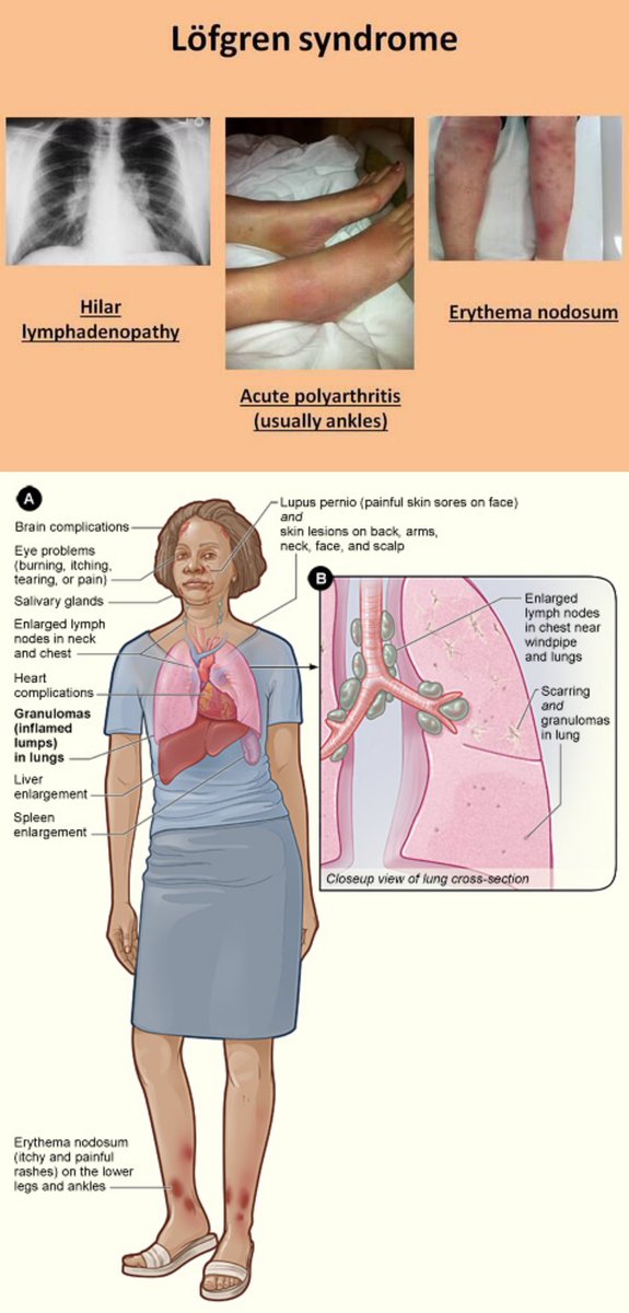 @AaronGoodman33 Löfgren syndrome type of acute sarcoidosis erythema nodosum (especially of the lower extremities),bilateral arthritis of the ankle joints, and hilar lymphadenopathy. described by Sven Halvar Löfgren, a Swedish clinician. NSAIDs,Colchicine or low-dose prednisone