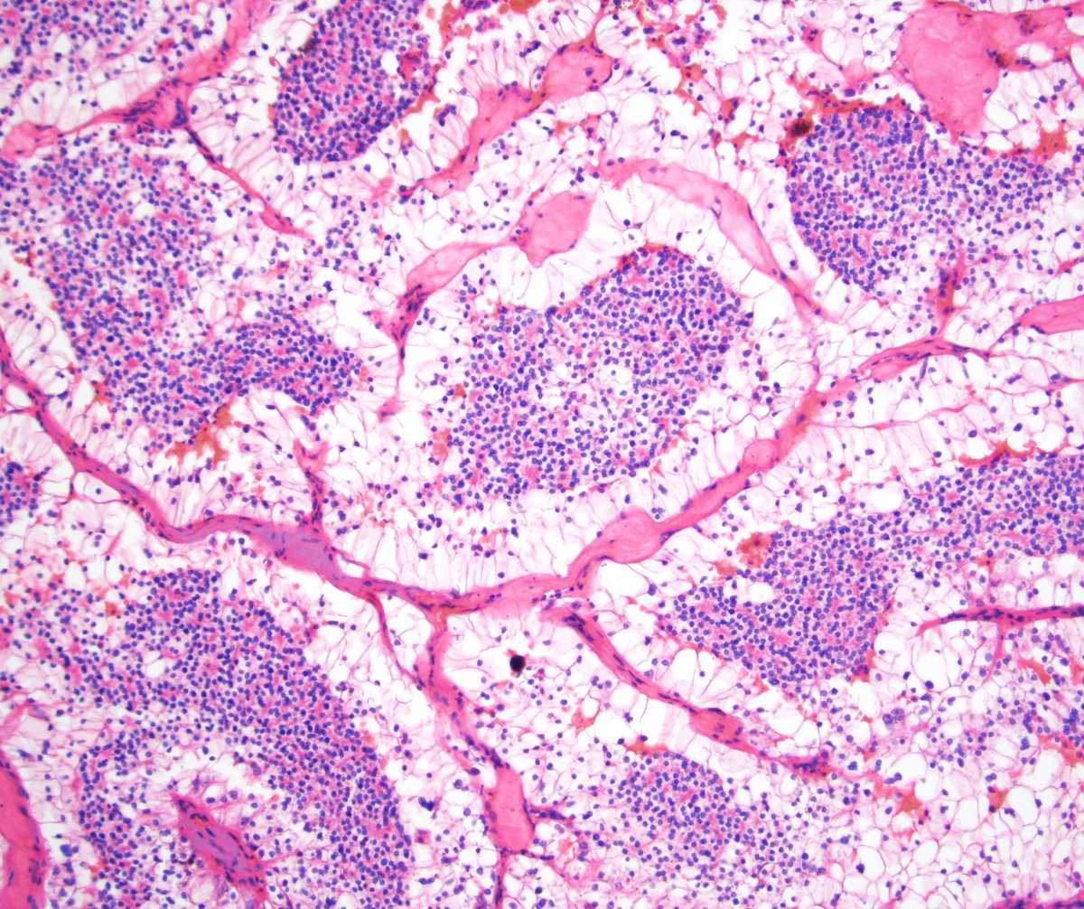 drmehrarohit's tweet image. Great case of TFE3-rearranged RCC with beautiful biphasic morphology- also shows that biphasic pattern is not unique to TFEB RCC #kidneycancer #Genomics #gupath @UMichPath #pathology #pathresidents #MedTwitter