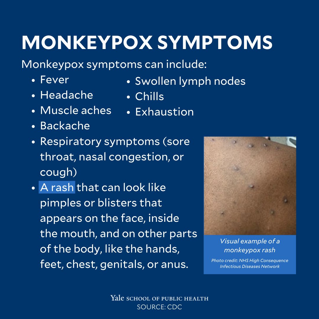 Yale School of Public Health on Twitter "Learn the signs of monkeypox