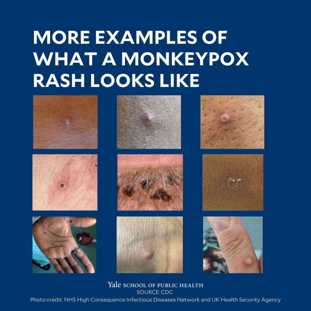 Yale School of Public Health on Twitter "Learn the signs of monkeypox