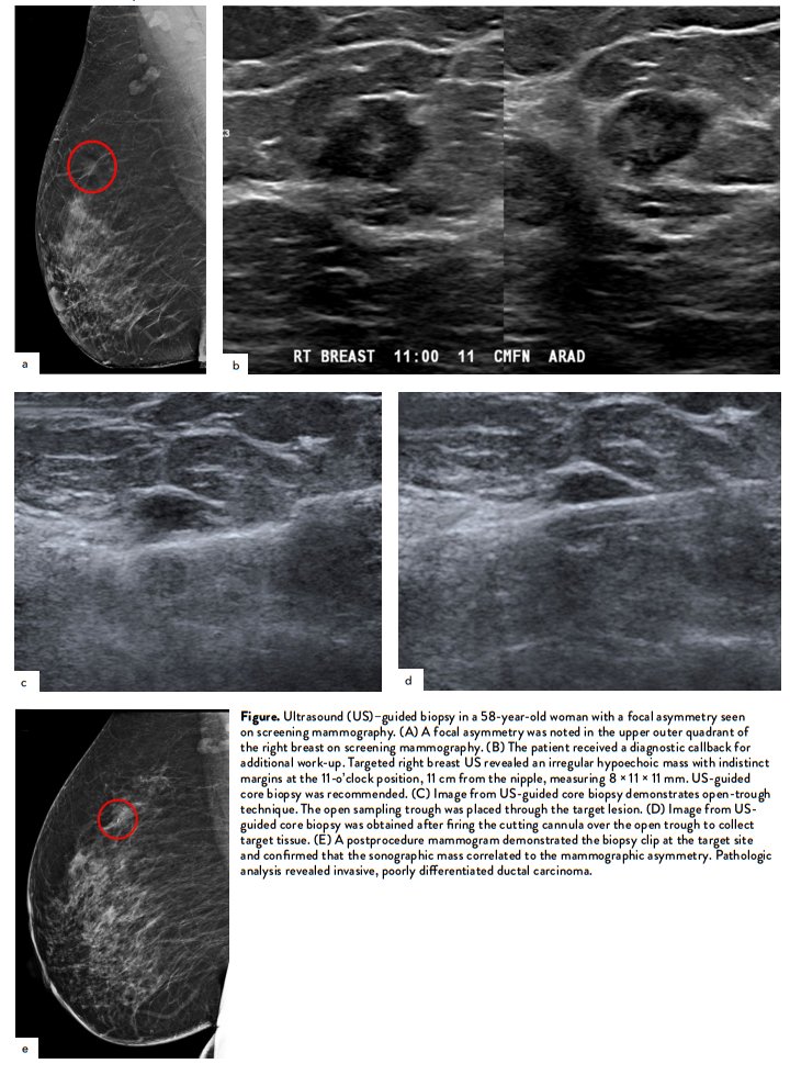 From the latest SBI newsletter: 'Tips & Tricks for Trainees in Breast Interventions: Ultrasound-Guided Biopsy.' Read the full article here: bit.ly/3SBqgAd