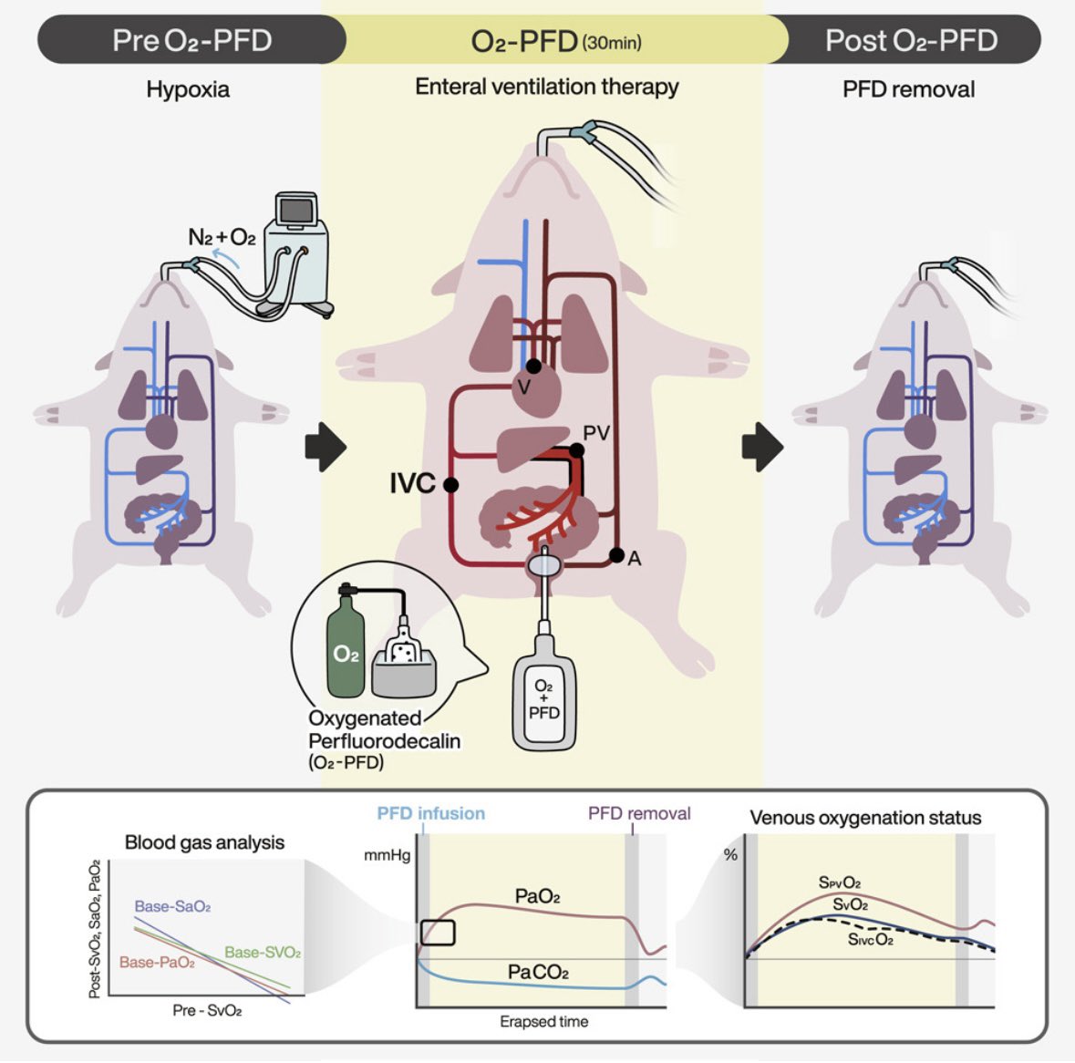 Anyone else predicting a major turf-war between the #ICU, #GI, and #Pulm over trans-anal oxygenation… Fujii et. al. demonstrate improvement in PaO2 by 6.6mmHg in hypoxemic 🐷 by using a continuous flow of O2-rich PFD via enema. #gitwitter #pedsgi 
doi.org/10.1016/j.isci…