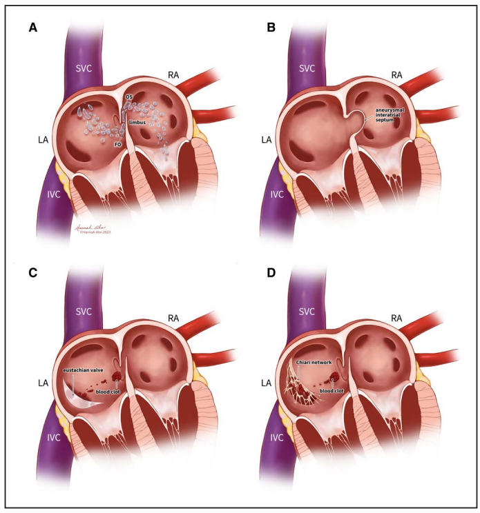 WorldStrokeEd's tweet photo. #MondayTip

☝️When you find a🫀right➡️left shunt on TTE/TCD in your <60 patient w/ cryptogenic ischemic stroke👉check for high-risk #PFO features:
🫧number of bubbles
🕳️aneurysmal interatrial septum
👂eustachian valve
🕸️Chiari network
#PASCAL
#RoPE
🔗https://t.co/kaohjYgAA2 https://t.co/oyH3znTA2l