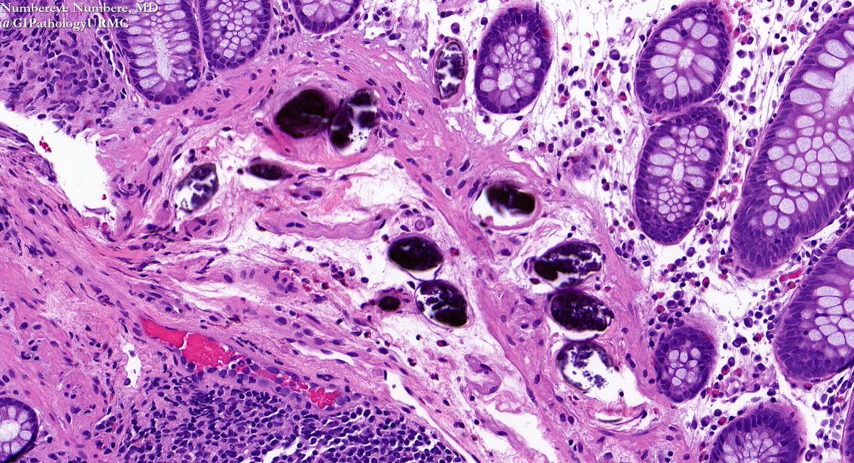 A unique find: Tubular adenoma meets Schistosoma eggs in this colon polyp! 📸 #SurgPath #GIPath #PathBoards #Histopathology #PathologyCases #Grossing #PathTweetorial #PathTweetAward #pathx #pathtwitter