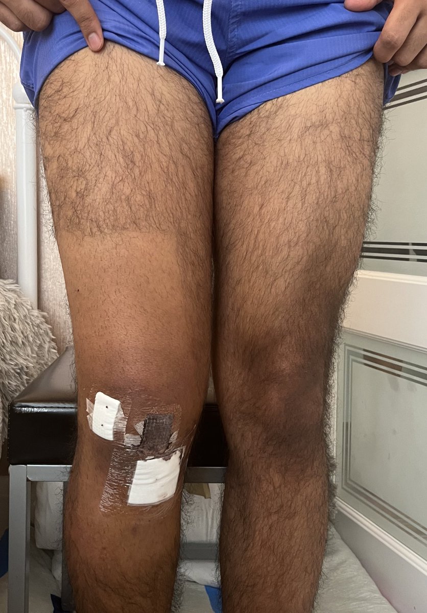 rxkz_01's tweet photo. Lost all my leg muscle after ACL surgery and made it back 2x 5 months later 😉 https://t.co/FNiN53hs96