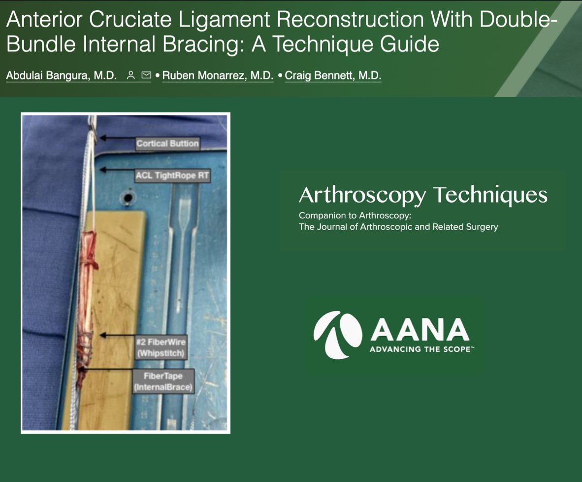 ArthroscopyJ's tweet photo. #AnteriorCruciateLigament #ACL #Reconstruction with #DoubleBundle #InternalBrace... 
https://t.co/vfiENi4nyY
With Technical Video:
https://t.co/ko6ISJZJxf https://t.co/ijkwdyEfe4