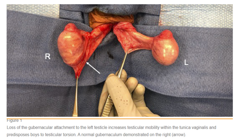 💣❗🚩 TESTICULAR TORSION - BELL CLAPPER DEFORMITY 

Best photo explaining bell clapper deformity - anatomical variant predisposing to testicular torsion.

Torsion = time critical emergency. 

What suture will you use for orchiopexy? 

Paper by <a href="/uro_nima/">Nima Nassiri, MD</a> @DrAsanad (link 👇)