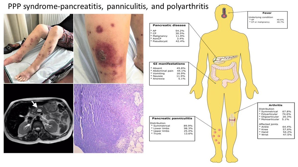 schowardjd's tweet photo. @drkeithsiau 75/👴🏼p/w pancreatic mass, nodular lesions on shins, lumps on forearms, pain around elbows, &amp; PMHx of portal vein thrombosis. 

DDx: PPP syn 2° ACCP or pseudocyst / cutaneous mets / EN / Trousseau's syn

[image credit: @ABetrains via @ClinRheumatol  https://t.co/6RMksNyTQ1] https://t.co/z6HKaT8QNc