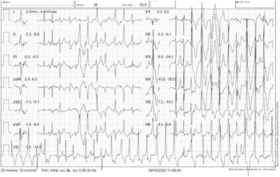 Catecholaminergic polymorphic ventricular tachycardia in young athletes: a rare but potentially fatal disease. Test your knowledge based on this #exercise test

escardio.org/Sub-specialty-…
#ESC_EAPC #CVPrev #SportsCardiology