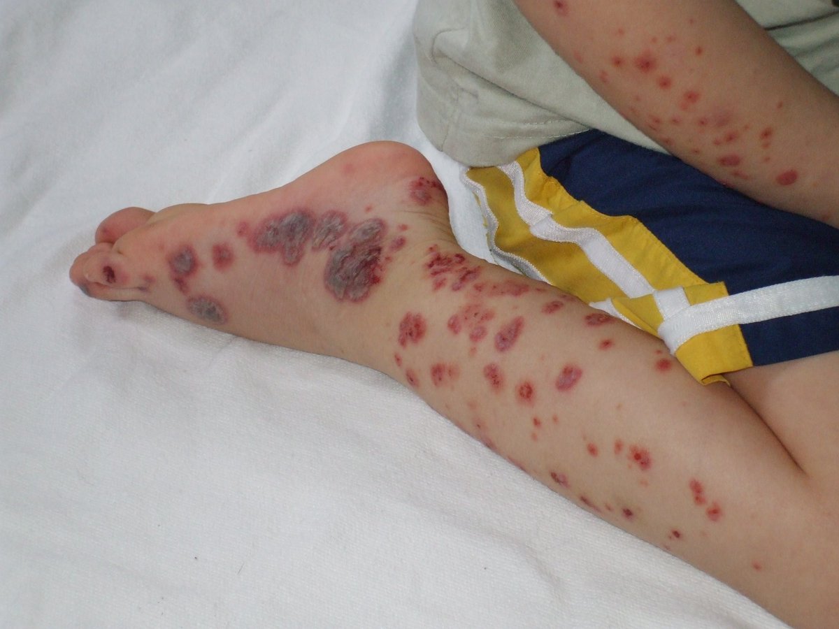 docxusofficial's tweet photo. Patient presents with rash, joint pain, and abdominal pain
Diagnosis ? https://t.co/MKbbVtosa5