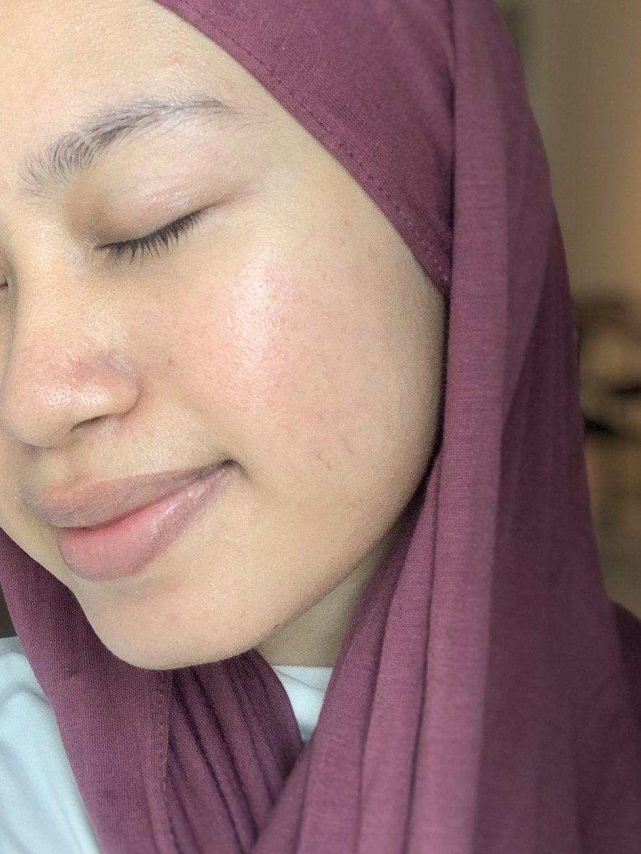 k1naas's tweet photo. Siapa skin cepat naik redness &amp; sunburn lepas buat outdoor activities boleh try #C8Yourself✨brightening serum @NaturesPalette_. 

I dapat dalam PR haritu &amp; dah try on my skin yang ada redness after effect pergi pantai&amp; main zipline. 2 weeks camtu je skin i dah ok balik 👍🏻 https://t.co/699CgeQDWS
