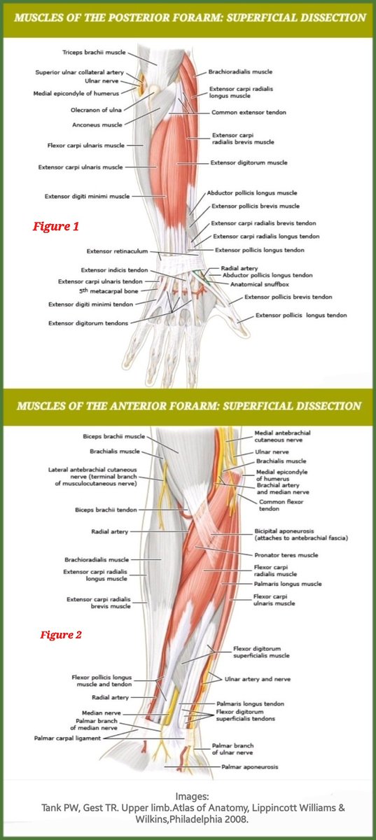 OBandarchi's tweet photo. Lateral epicondyle of elbow is bony origin for wrist EXTENSORS (fig 1);

Medial epicondyle is bony origin for wrist FLEXORS (fig 2).

Pain at tendon insertion of these muscles referred to as lateral epicondylitis (Tennis elbow) &amp; medial epicondylitis (Golfer's elbow, respectively https://t.co/Us0X3OQgFu